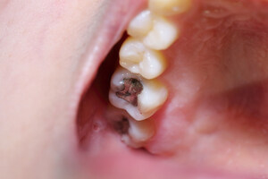 International Group Supports Global Efforts To End Dental Mercury Usage