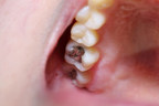 International Group Supports Global Efforts To End Dental Mercury Usage