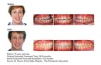 Journal of Clinical Orthodontics Publishes Case Study Highlighting Accelerated Tooth Movement When AcceleDent is Integrated into Orthodontic-Orthognathic Surgery Cases