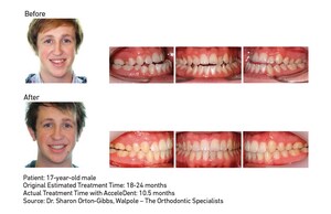 Journal of Clinical Orthodontics Publishes Case Study Highlighting Accelerated Tooth Movement When AcceleDent is Integrated into Orthodontic-Orthognathic Surgery Cases