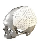 OssDsign Announces FDA 510(k) Clearance of OSSDSIGN® Cranial for Sale in the USA