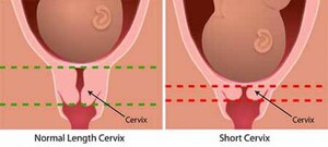 Juniper Pharmaceuticals Presents Poster at SMFM 2017 on Current Practice Among U.S. Obstetricians to Screen, Define, and Treat a Short Cervix to Prevent Preterm Birth