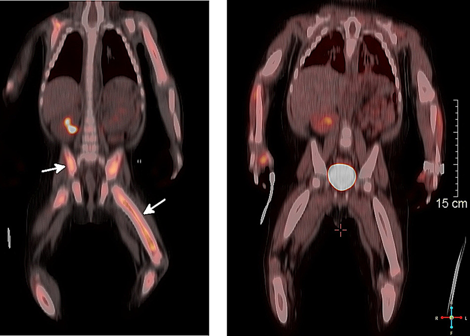 PET-CT images of a 10-month-old child with Langerhans cell histiocytosis (LCH) show increased disease activity in the bones (left image). Three months after the start of oral therapy with the drug dabrafenib, the image on the right shows near complete resolution of disease activity. The child was part of a study in JCI Insight from Cincinnati Children's summarizing outcomes of off-label oral therapy in patients with histiocytoses that were resistant to chemotherapy. CREDIT: Cincinnati Children's
