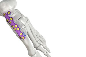 Paragon 28® launches robust Charcot and midfoot reconstruction system designed to address deformities of the medial column - Gorilla® Medial Column Plating System