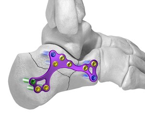 Paragon 28® launches comprehensive array of low profile plates to address calcaneal fracture through extensile or sinus tarsi approach-Gorilla® Calc Fracture Plating System