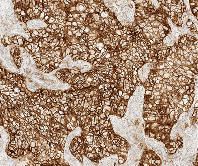 VENTANA PD-L1 (SP263) Assay staining in non-small cell lung cancer (NSCLC) with membranous and cytoplasmic staining of the tumor cells