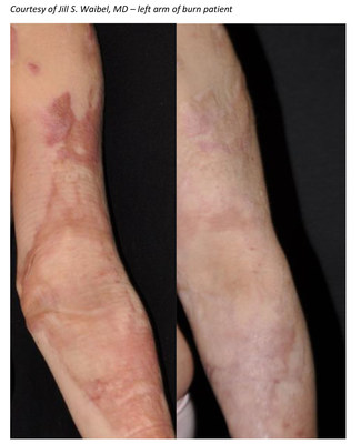 a) Burn scars on the bilateral lower extremities before treatment. (b)