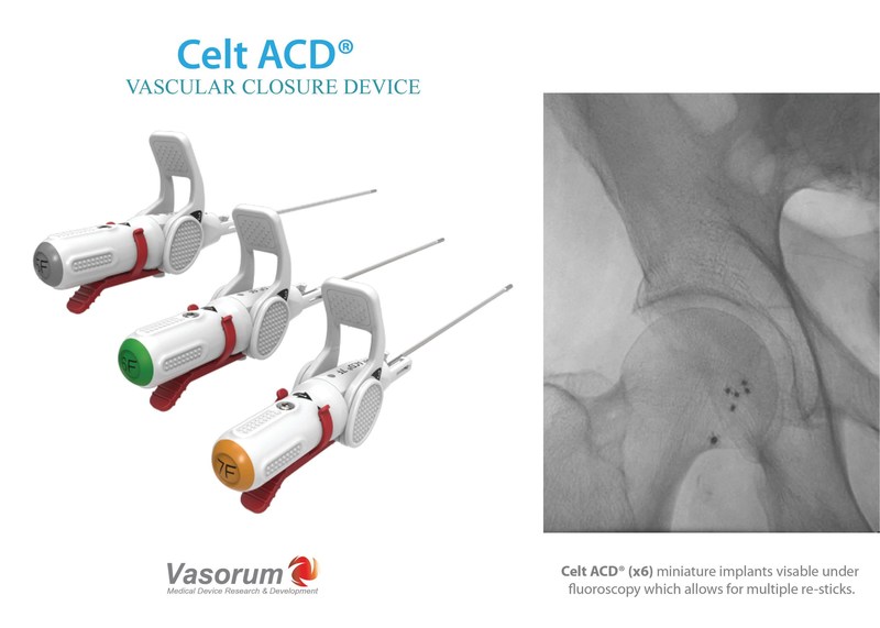 Celt ACD® Vascular Closure Device in 5F, 6F and 7F Sizes is indicated for arterial puncture closure in both diagnostic and interventional cardiology and radiology patients; it offers excellent time to hemostasis in a wide variety of clinical situations. Celt ACD® allows immediate closure of multiple re-sticks in patients with peripheral vascular disease. The device was designed to help achieve more efficient cath lab workflow by providing rapid and definitive closure therefore allowing for early patient ambulation and hospital discharge. (PRNewsfoto/Vasorum Ltd)