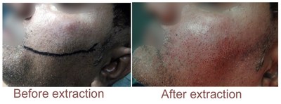 Breakthrough in Facial Hair Redesigning and Reshaping Dr. A s Clinic