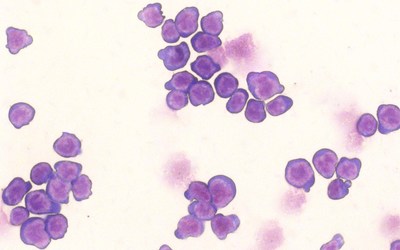 Immature blood cells (stained purple) do not divide into enough functioning red blood cells when defective. Researchers have discovered how to stop the protein signaling pathway that makes this defect so dangerous. Photo Credit: Zhang lab/CSHL, 2019