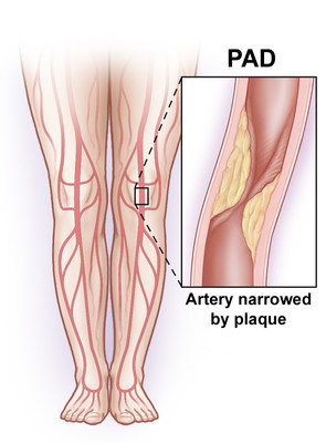 Leg artery disease, also called peripheral arterial disease (PAD) can be mild or deadly and should be treated by a vascular surgeon.