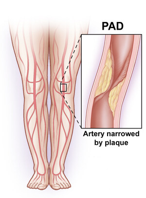 SVS: 5 things you need to know about leg artery disease