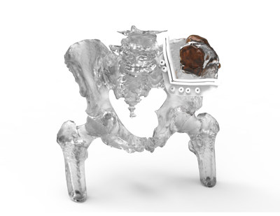 3D Systems&rsquo; FDA cleared VSP Orthopaedics solution enables surgeons to obtain a clear 3D visualization of a patient&rsquo;s anatomy and develop a personalized surgical plan, prior to entering the operating room.