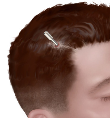 The NeuroBlate procedure is performed through a pencil-sized opening and is typically closed with one to two stitches. The NeuroBlate procedure is performed through a pencil-sized opening and is typically closed with one to two stitches.