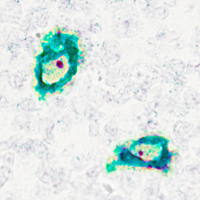 CD68/SR-D1 RNA and protein expression was detected in human tonsil tissue using dual RNAscope ISH and IHC. Staining shows CD68/SR-D1 RNA expression (red) matches its protein expression (green) in tonsil lymphocytes. CD68/SR-D1 RNA and protein expression was detected in human tonsil tissue using dual RNAscope ISH and IHC. Staining shows CD68/SR-D1 RNA expression (red) matches its protein expression (green) in tonsil lymphocytes.