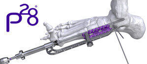 Paragon 28® adds PRECISION® Reduction Guide to its Joust™ Beaming Screw System - Reduction of the Medial Column and Precision Placement of the Beam with First of Its Kind Instrument
