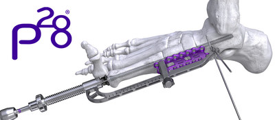 Joust&trade; PRECISION&reg; Reduction Guide