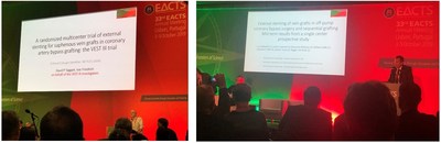 Prof. David Taggart, Oxford, UK (Left) and Prof. Luca Weltert, Rome, Italy (Right) Presenting the latest clinical experience with VEST technology at the EACTS 2019 Annual Meeting in Lisbon, Portugal. Prof. David Taggart, Oxford, UK (Left) and Prof. Luca Weltert, Rome, Italy (Right) Presenting the latest clinical experience with VEST technology at the EACTS 2019 Annual Meeting in Lisbon, Portugal.
