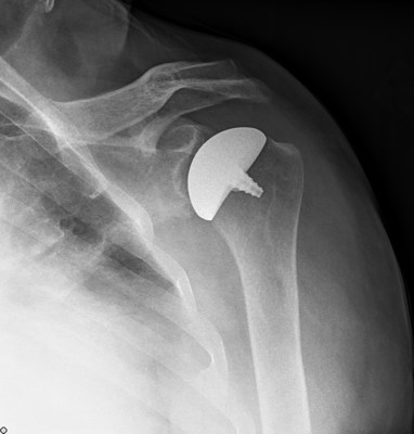 Shoulder Osteoarthritis (OA) treated with the nonspherical Arthrosurface OVO with Inlay Glenoid Arthroplasty System. New data demonstrates excellent clinical benefits, including pain relief and increased range of motion in patients with glenohumeral (GH) arthritis. Allows patients to resume an active lifestyle with no activity restrictions.