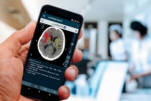 Using Simple Brain Scans Brainomix AI Software Can Generate Critical Information for the Treatment of Stroke Patients