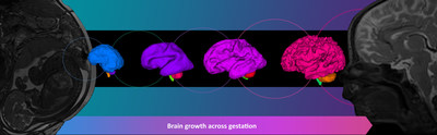 As pregnancy progresses, the fetal brain grows larger and more complex, forming the foundation on which infants are able to learn to walk, run and speak; how children master new lessons in school; and how teenagers are able to hold a job and become productive adults. 3-D magnetic resonance images show human brain growth in the womb (18 gestational weeks, 26 gestational weeks, 32 gestational weeks) and in the postnatal period at 4 weeks of life.
Image credit: Children’s National Hospital As pregnancy progresses, the fetal brain grows larger and more complex, forming the foundation on which infants are able to learn to walk, run and speak; how children master new lessons in school; and how teenagers are able to hold a job and become productive adults. 3-D magnetic resonance images show human brain growth in the womb (18 gestational weeks, 26 gestational weeks, 32 gestational weeks) and in the postnatal period at 4 weeks of life.
Image credit: Children’s National Hospital