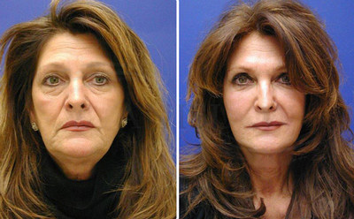 Before and after photos illustrate a natural transformation by artistic facial plastic surgeon Dr. Paul Stanislaw with the Stanislaw Facial Plastic Surgery Center in Avon, CT that offers fly-in facelifts for out of area patients. Before and after photos illustrate a natural transformation by artistic facial plastic surgeon Dr. Paul Stanislaw with the Stanislaw Facial Plastic Surgery Center in Avon, CT that offers fly-in facelifts for out of area patients.