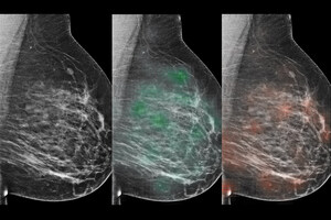 Combination of Artificial Intelligence and Radiologists More Accurately Identified Breast Cancer