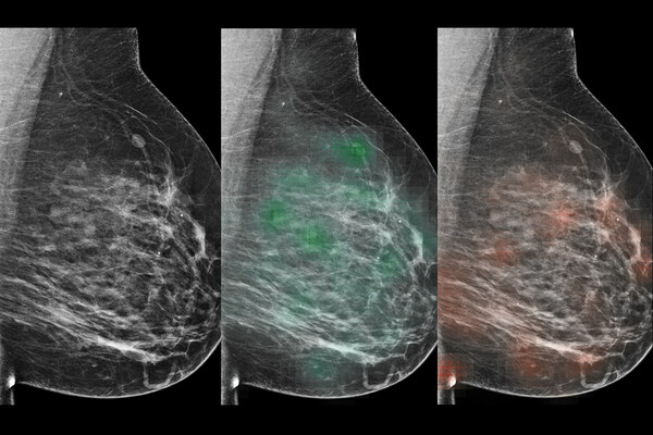 An AI tool learned to predict which lesions were likely malignant (red “heatmap”) or likely benign (green heatmap), with potential to aid radiologists in the diagnosis of breast cancer.