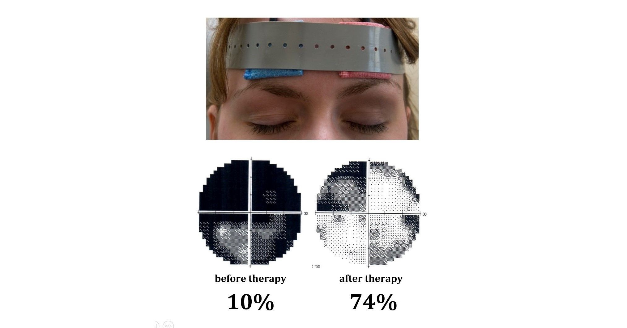 New Hope For Patients With Vision Loss At Savir Center For Vision