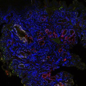 TissueCypher® Further Validated to Accurately Risk Stratify Barrett's Esophagus Patients With Non-Dysplastic or Low-Grade Dysplasia Diagnoses: Findings Shared at Two Major GI Conferences