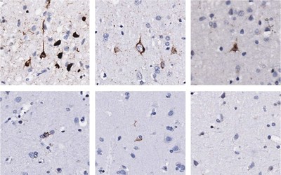 TDP-43 protein builds up in motor cortex and spinal cord of ALS patients, causing the nerves to die. The top three panels show nerve cells of ALS patients with extensive TDP-43 pathology in the motor cortex. Other ALS patients show little to no TDP-43 pathology, and look more like controls. Credit: Gale Hammell lab/CSHL, 2019