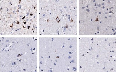 TDP-43 protein builds up in motor cortex and spinal cord of ALS patients, causing the nerves to die. The top three panels show nerve cells of ALS patients with extensive TDP-43 pathology in the motor cortex. Other ALS patients show little to no TDP-43 pathology, and look more like controls. Credit: Gale Hammell lab/CSHL, 2019 TDP-43 protein builds up in motor cortex and spinal cord of ALS patients, causing the nerves to die. The top three panels show nerve cells of ALS patients with extensive TDP-43 pathology in the motor cortex. Other ALS patients show little to no TDP-43 pathology, and look more like controls. Credit: Gale Hammell lab/CSHL, 2019