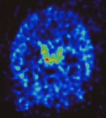 PET image showing brain delivery of radiolabeled etanercept after perispinal injection. Transverse section of a living rat
brain following perispinal administration of Cu64-DOTA etanercept, imaged minutes following perispinal injection. Note the enhanced signal in the choroid plexus and cerebrospinal fluid within the cerebral ventricles. Modified from Tobinick EL, Chen K, Chen X. BMC Res Notes. 2009;2:28, used under the Creative Commons License 2.0. PET: positron emission tomography. PET image showing brain delivery of radiolabeled etanercept after perispinal injection. Transverse section of a living rat
brain following perispinal administration of Cu64-DOTA etanercept, imaged minutes following perispinal injection. Note the enhanced signal in the choroid plexus and cerebrospinal fluid within the cerebral ventricles. Modified from Tobinick EL, Chen K, Chen X. BMC Res Notes. 2009;2:28, used under the Creative Commons License 2.0. PET: positron emission tomography.
