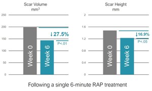 Soliton Announces Positive Interim Clinical Trial Results with 27% Average Reduction in Scar Volume From Single Non-Invasive Treatment