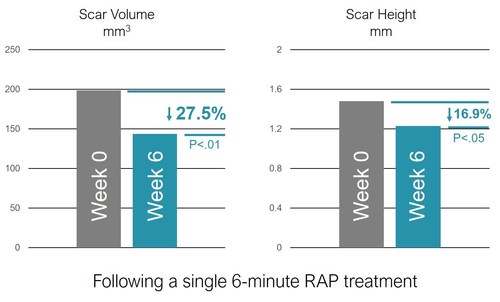 Soliton announces positive interim clinical trial results with 27% average reduction in scar volume from single
non-invasive treatment. The graph provides a recap of the average for nine scars as one patient was not able to come in for this 6-week timepoint. (PRNewsfoto/Soliton, Inc.)