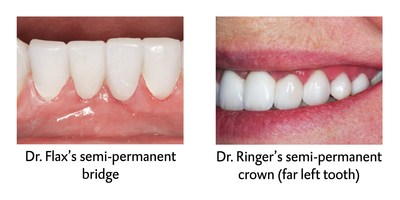 Post-treatment photos of restorations made using LuxaCrown