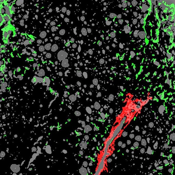 Fine Collage (green) - Assembled Collagen (red) - Steatosis (gray with white, dotted lines circumference)