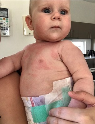 As a baby, steroid cream did not help Kali-Rose's eczema