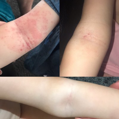 Kali-Rose's arm in June 2019 and a month later after using Childs Farm in July 2019