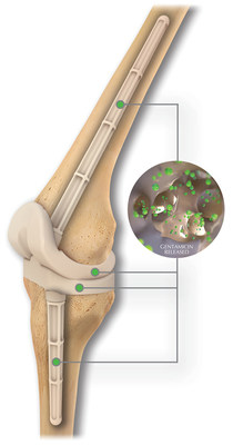 The REMEDY® Stemmed Knee Spacer's interconnected pores allow for extended antibiotic elution while improving OR efficiency vs handmade IM dowels.