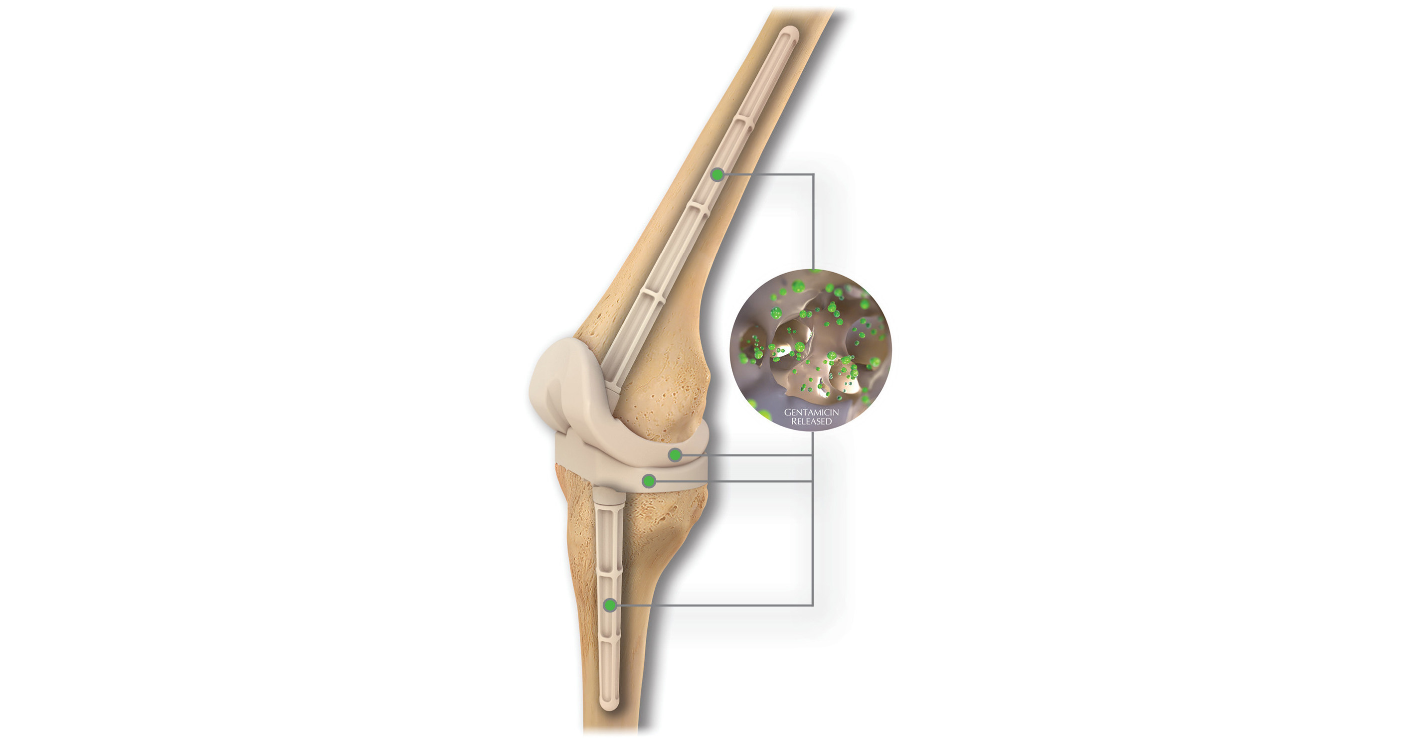 OsteoRemedies® Announces the Full Commercial Launch of the First