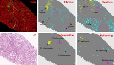 qFIBS is employed to automatically recognize the key features of NASH in various regions of the Central Vein (CV), Portal Tract (PT), and Perisinusoidal (PS) within the liver biopsies, before generating a fully quantified and consistent analysis of the images to determine the severity and monitor the changes in fibrosis, lobular inflammation, hepatocyte ballooning and steatosis, which are minute yet important. Picture Credits: © HistoIndex qFIBS is employed to automatically recognize the key features of NASH in various regions of the Central Vein (CV), Portal Tract (PT), and Perisinusoidal (PS) within the liver biopsies, before generating a fully quantified and consistent analysis of the images to determine the severity and monitor the changes in fibrosis, lobular inflammation, hepatocyte ballooning and steatosis, which are minute yet important. Picture Credits: © HistoIndex
