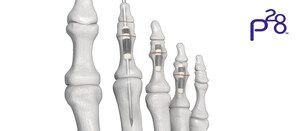 Paragon 28® launches sterile kit to streamline delivery of its transformational HammerTube™ Hammertoe System