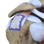 New study shows 96% healing of hard to treat large and massive rotator cuff tears with Smith+Nephew's REGENETEN™ Bioinductive Implant