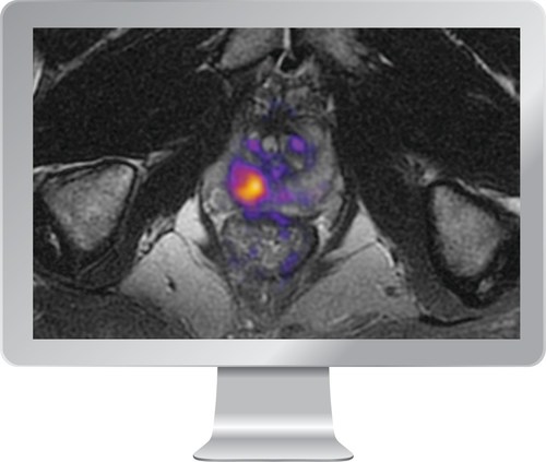 RSI-MRI+ is FDA-cleared imaging software that increases the visibility of restricted water, a hallmark feature of cancerous tissue, to help improve early detection and diagnosis of prostate cancer.