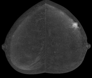 American College of Radiology, Breast Cancer Research Foundation and GE Healthcare Announce a Planned Trial to Evaluate Use of Contrast Enhanced Mammography for Screening Women with Dense Breasts