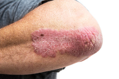A case of moderate psoriasis shown on patient (CNW Group/AbbVie)