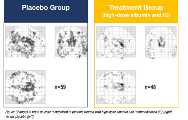 Changes in brain glucose metabolism in patients treated with high-dose albumin and immunoglobulin (IG) [right] versus placebo [left].