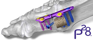 Paragon 28® Launches Unique Option for Revising a Failed Synthetic Cartilage Implant (SCI)