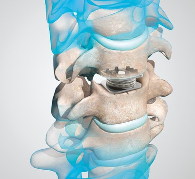 The M6-C™ artificial cervical disc is an innovative next-generation option for patients needing artificial disc replacement as an alternative to spinal fusion. The illustration pictures the device implanted between two vertebrae.